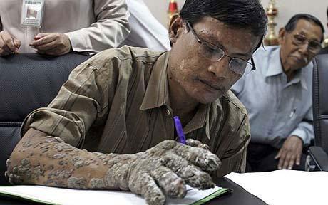 印尼『树人』术后树皮复生 每年最少割两次(组图)