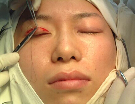 准备再将自己的双颊削去2~3毫米,整容医生却拒绝给小茹进行手术,理由