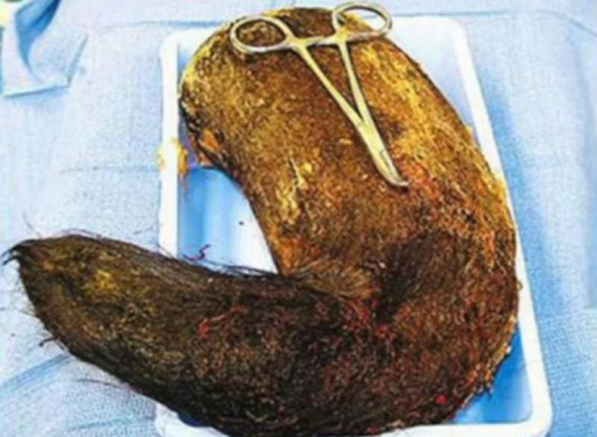 盘点各国异食癖患者,都是重口味(组图)